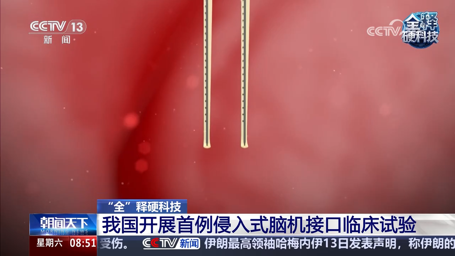 我国首例侵入式脑机接口临床试验成功开展(图2)