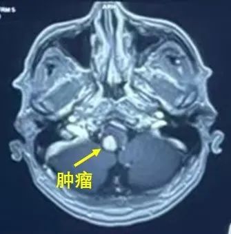 西安交大一附院神经外科团队精准攻克脑干恶性肿瘤(图2)