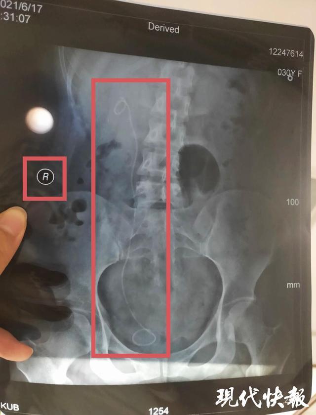 医生左右不分把支架装进正常输尿管三名医生医疗事故仅处罚一助手(图2)