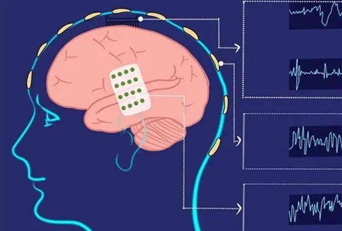 脑机接口长期稳定植入 精准意念操控20多种设备(图1)