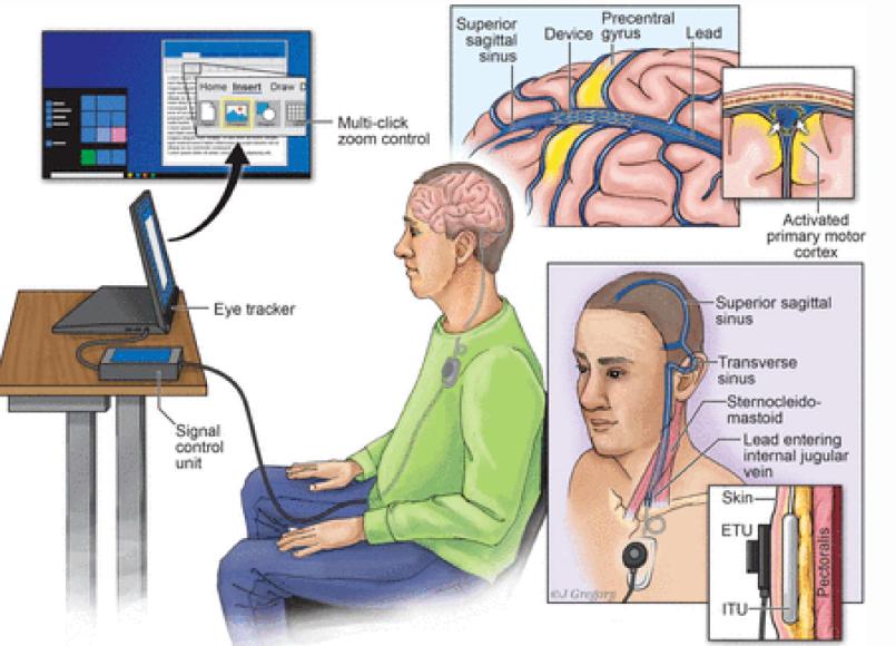 深圳科学家研发出“神经蠕虫” 直径196微米、可在颅内自由游走标志脑机接口技术迈入动态时代(图1)