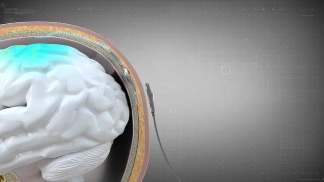 “意念取物”成真！江苏首家脑机接口临床研究病房帮助瘫痪8年患者重获“动手能力”(图3)