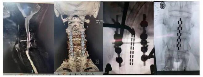 贵州首例！这家医院成功实施“有创脑机接口术”(图1)