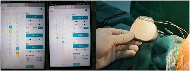 贵州首例！这家医院成功实施“有创脑机接口术”(图2)
