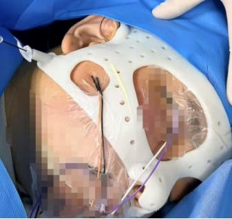 告别“凭经验”!达州市二医院开展3D打印辅助精准神经调控术(图3)