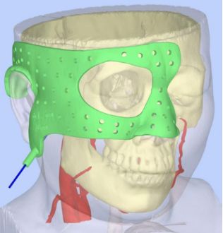 告别“凭经验”!达州市二医院开展3D打印辅助精准神经调控术(图1)