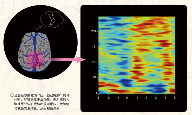 脑机接口技术如何让意识发声？(图5)