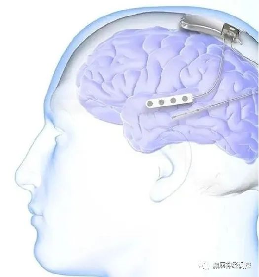 亲身体验“意念行走”《环球时报》记者现场直击脑机接口最新成果(图1)
