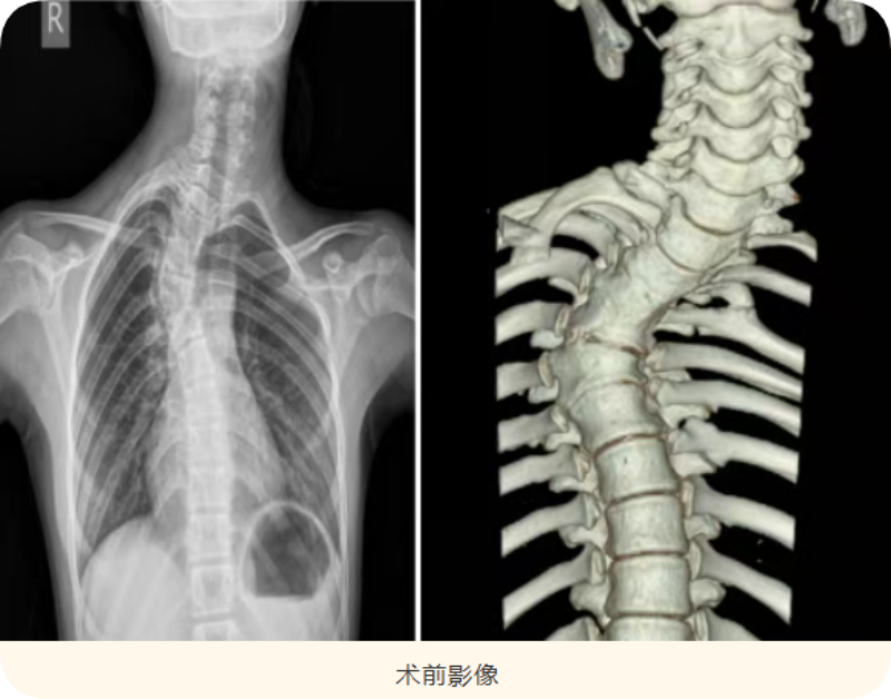 川东北首例！重度脊柱侧弯患儿在北京安贞医院南充医院挺直脊梁(图1)